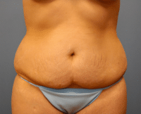 Tummy Tuck