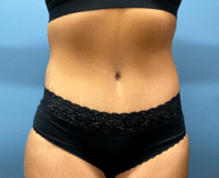 Tummy Tuck