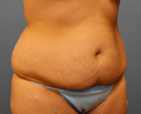 Tummy Tuck