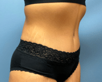 Tummy Tuck