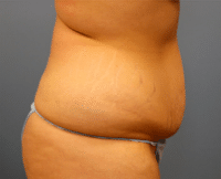 Tummy Tuck