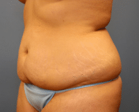 Tummy Tuck