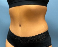 Tummy Tuck