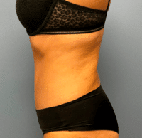 Tummy Tuck