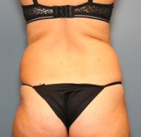 Tummy Tuck