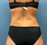 Tummy Tuck