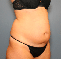 Tummy Tuck