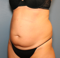 Tummy Tuck