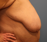 Breast Reduction