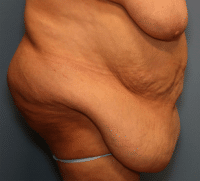 Panniculectomy