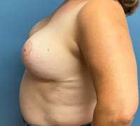 Breast Reduction