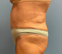 Tummy Tuck