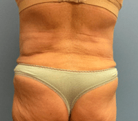 Tummy Tuck