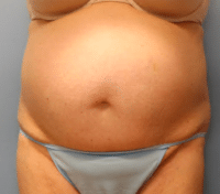 Tummy Tuck