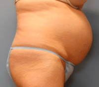 Tummy Tuck