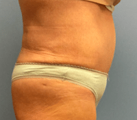 Tummy Tuck