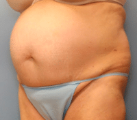 Tummy Tuck