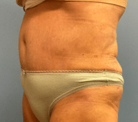 Tummy Tuck