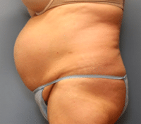 Tummy Tuck