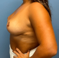 Breast Reduction