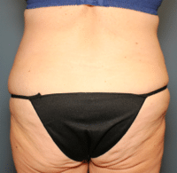 Circumferential Body Lift