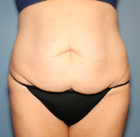 Circumferential Body Lift