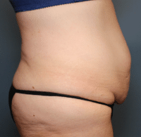 Circumferential Body Lift