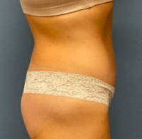 Circumferential Body Lift