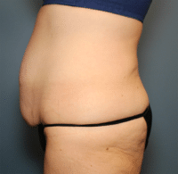 Circumferential Body Lift