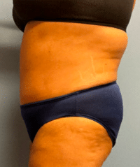 Tummy Tuck