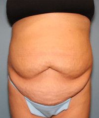 Tummy Tuck