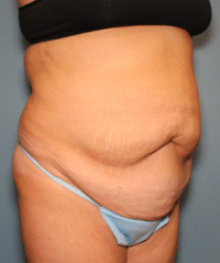 Tummy Tuck