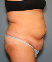 Tummy Tuck