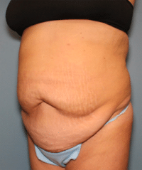 Tummy Tuck