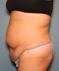 Tummy Tuck