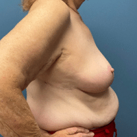 Breast Reduction