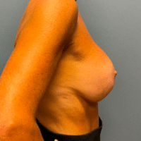 Breast Augmentation