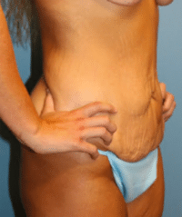 Tummy Tuck