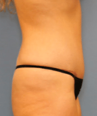 Tummy Tuck