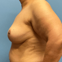 Breast Reduction