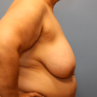 Breast Reduction