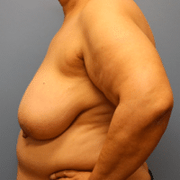 Breast Reduction