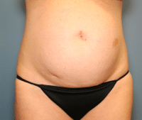 Tummy Tuck