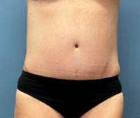 Tummy Tuck