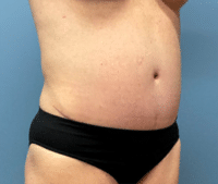 Tummy Tuck