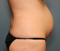 Tummy Tuck