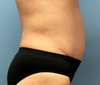 Tummy Tuck