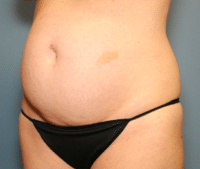 Tummy Tuck