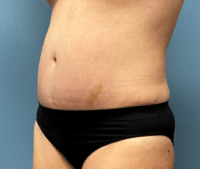 Tummy Tuck