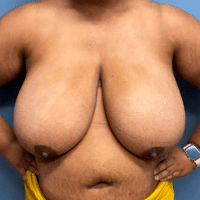 Breast Reduction